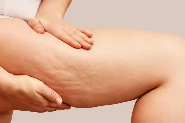 Image of woman showing leg with cellulite Livingston