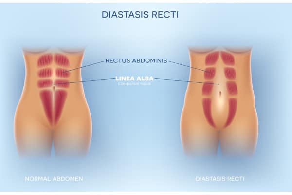 What Non-Surgical Options Are Available for Diastasis Recti Livingston?