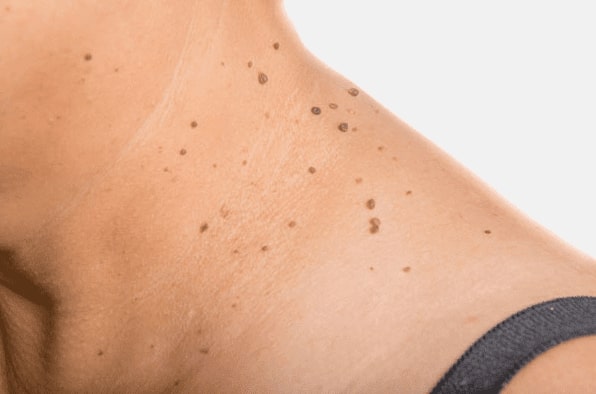 Are you looking for easy skin tag removal Livingston - then contact Spire today!