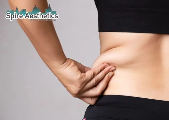 Image of woman pinching fat on their hips Livingston. Fat Freezing treatment