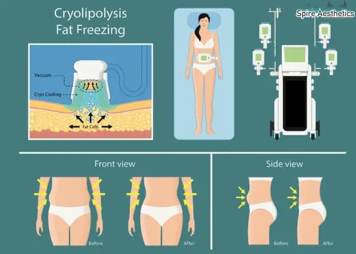 Fat freezing treatment Livingston benefits for competitions to remove stubborn fat deposits.