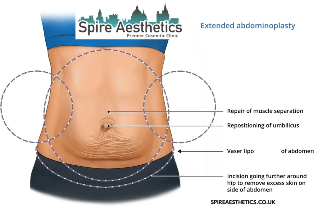 Understanding Loose Skin After Gastric Band Livingston Surgery and HIFU Treatment