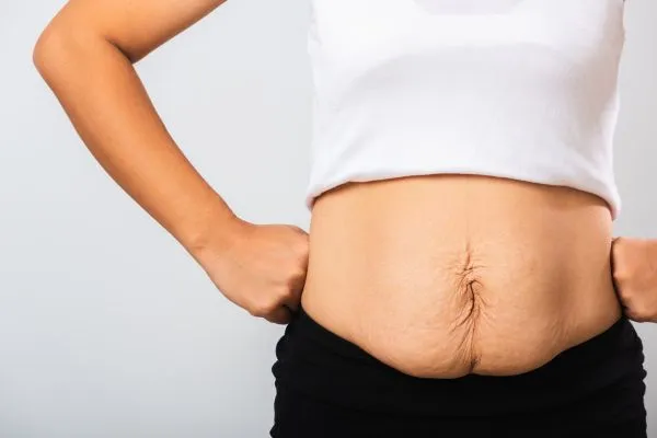 Image of a woman's stomach after weight loss with sagging skin following a gastric band Livingston