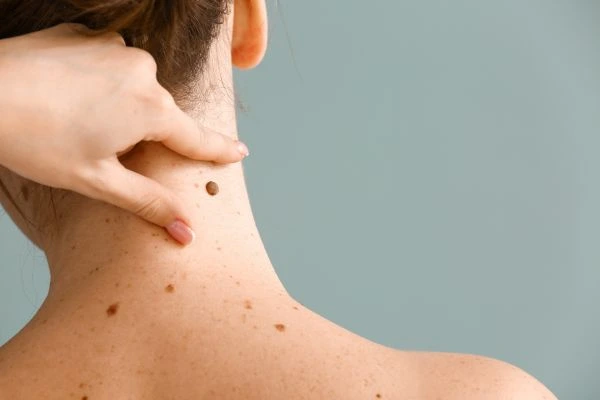 skin blemish removal Livingston treatment