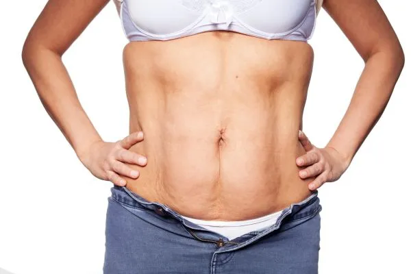 sagging skin on woman's stomach after weight loss injections Livingston