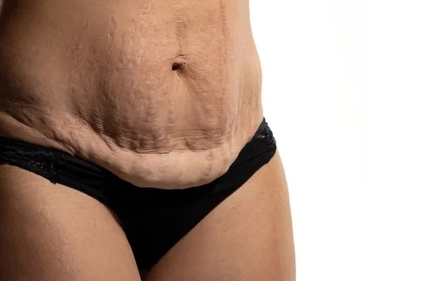 Image of womans stomach after weight loss injections Livingston showing saggy skin