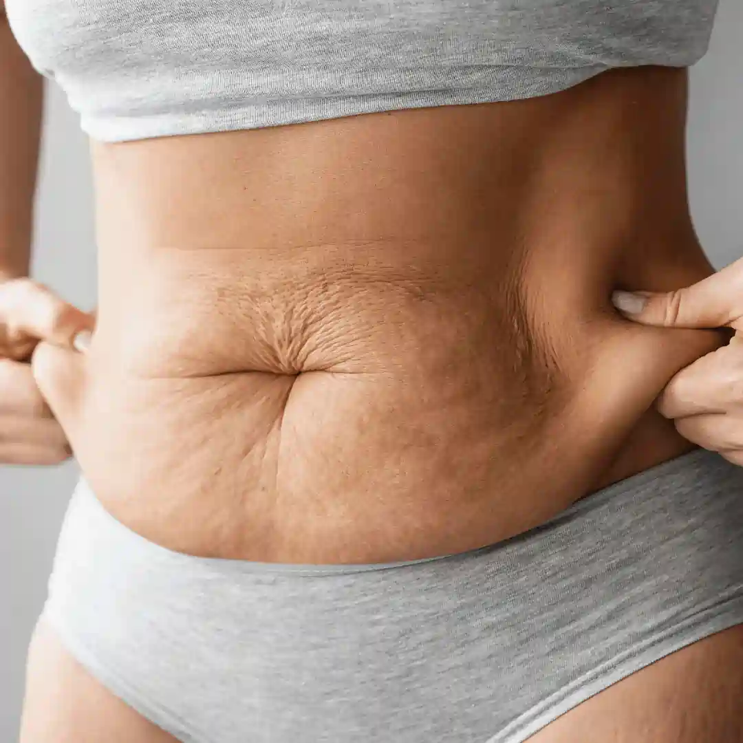 Is It Normal to Have Loose Skin After Pregnancy Livingston?
