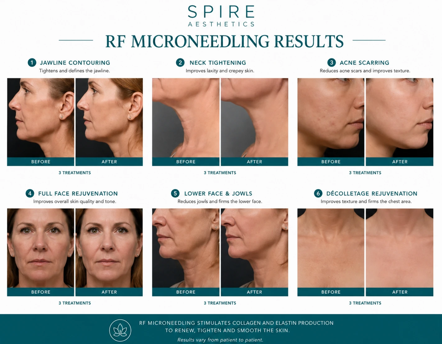 RF Microneedling Skin tightening Livingston results