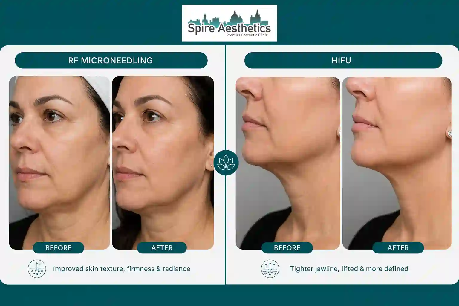 Can RF Microneedling and HIFU Be Combined Livingston?