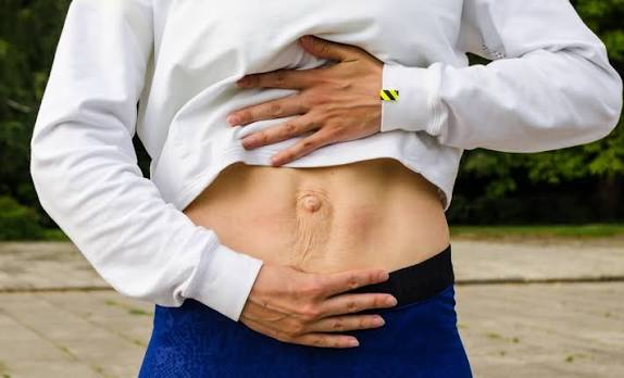 When Could Diastasis Recti Be the Missing Piece of the Puzzle Livingston?