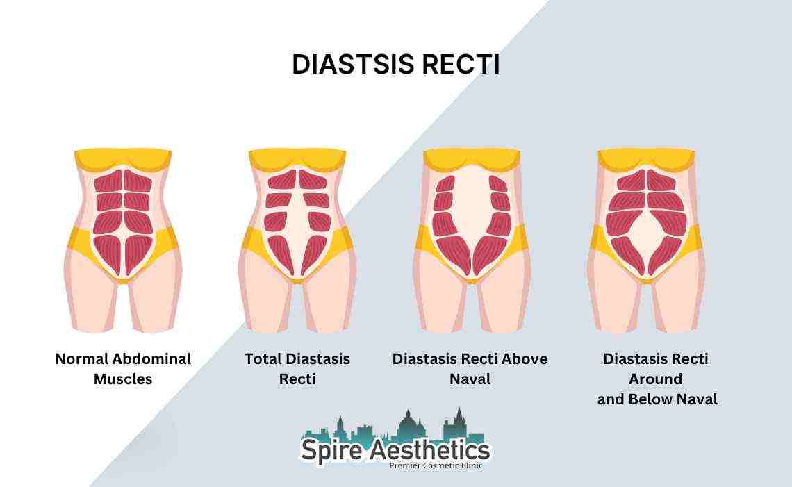 Is Non-Surgical Diastasis Recti Treatment Right for You? Common Concerns Answered Livingston